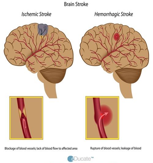Comparison of ischemic and hemorrhagic stroke-Definition